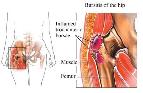 Hip Pain Location Diagram