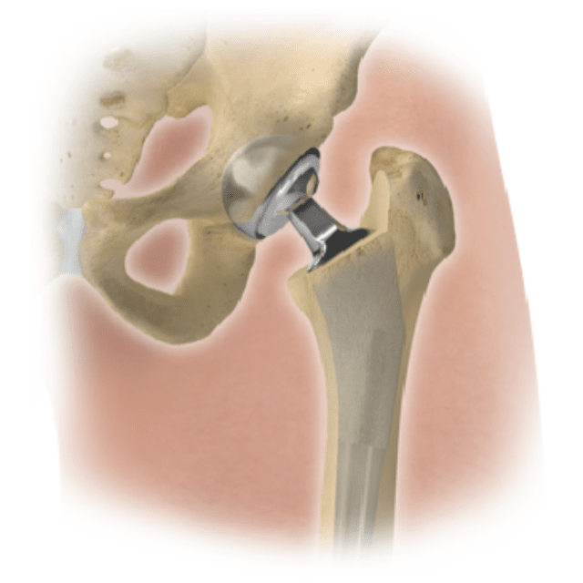 A diagram of a hip replacement
