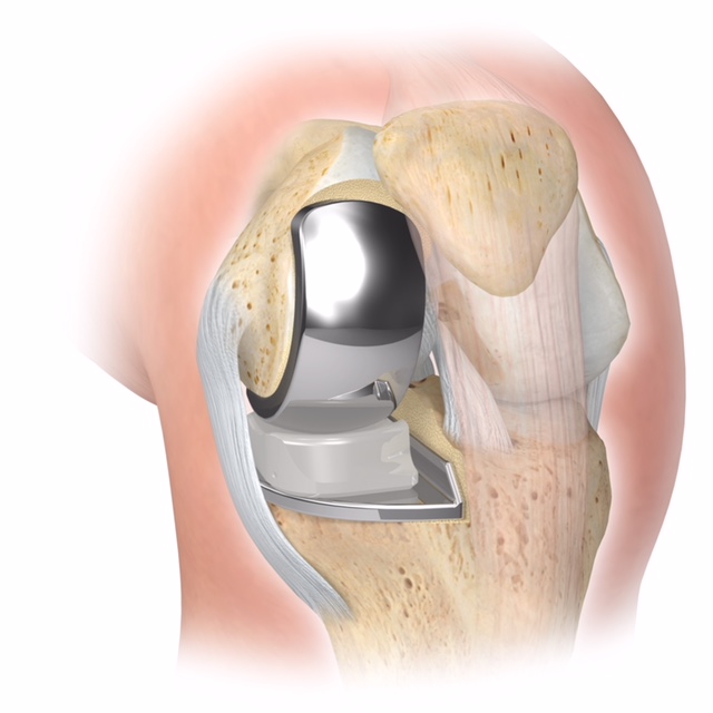 A diagram of a partial knee replacement