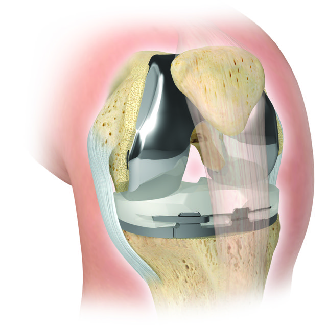 A diagram of a total knee replacement